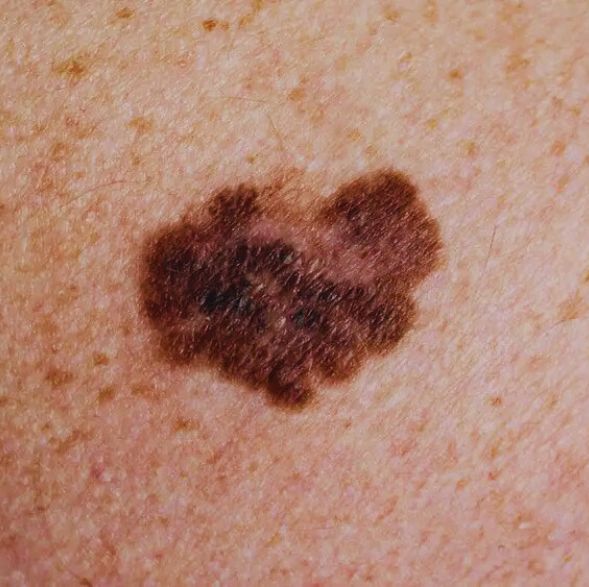 what does a melanoma mole with uneven borders look like