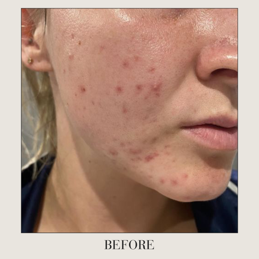 acne before treatment at ANO Cosmetics & Skin