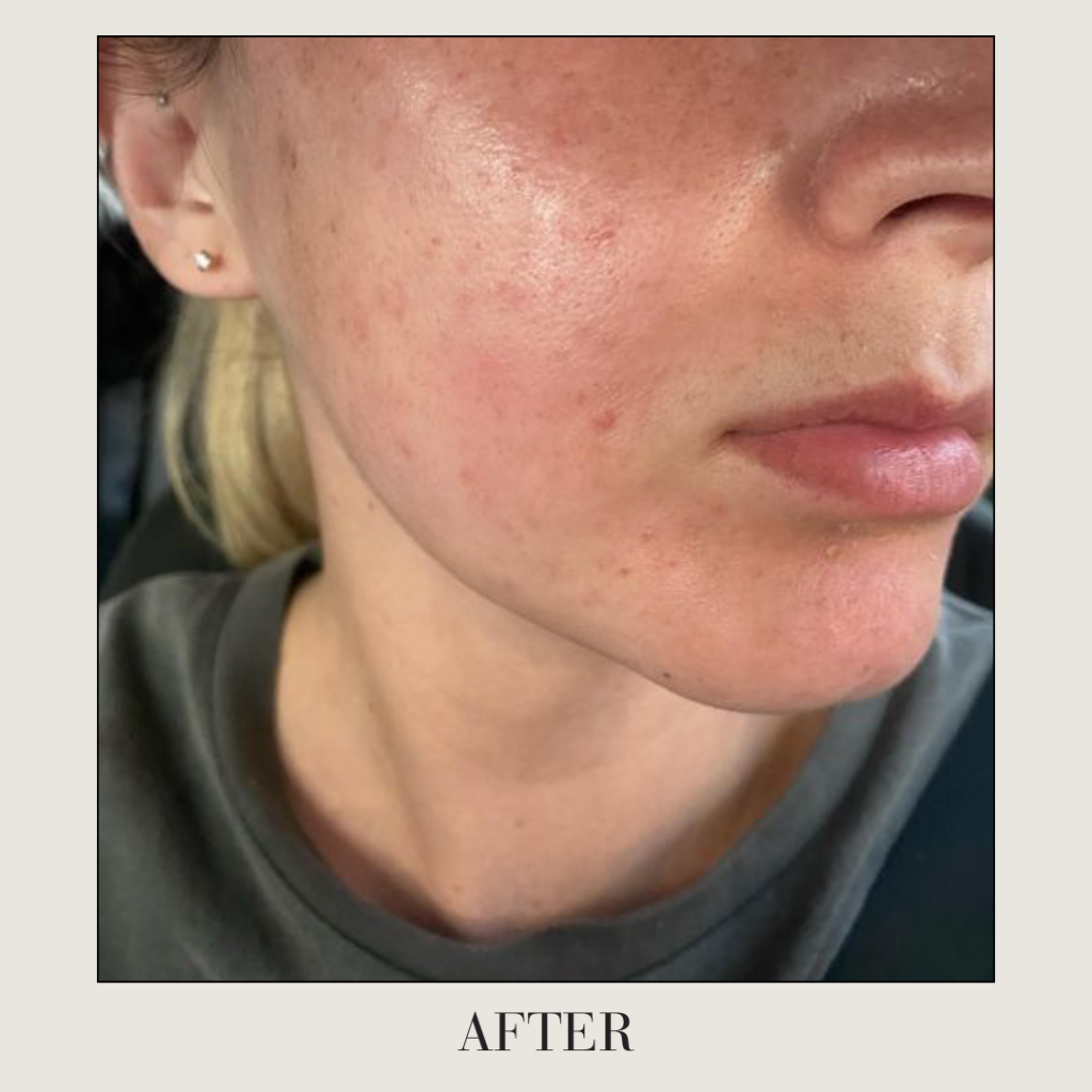 Clear skin after acne treatment at ANO Cosmetics & Skin