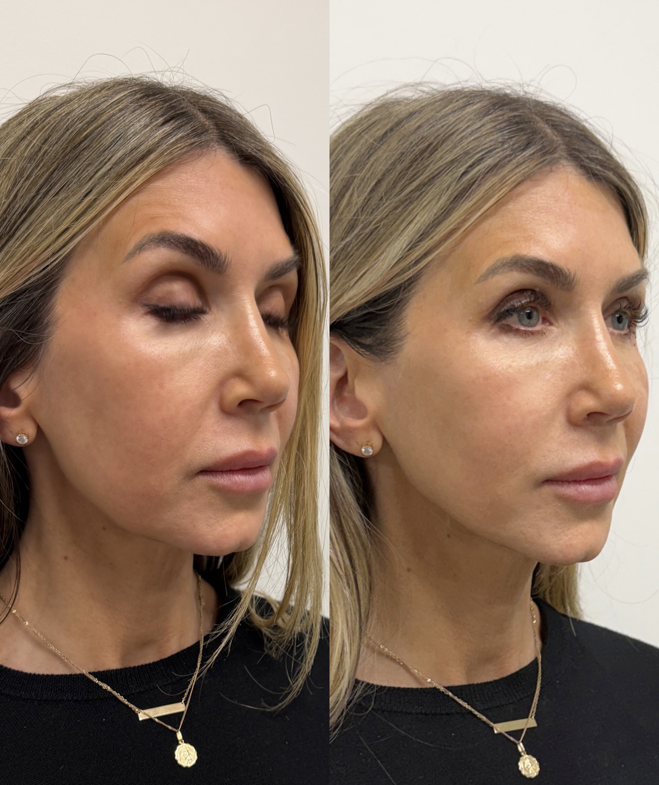 Before and after side profile photo showing skin tightening results from XERF at ANO Shepparton