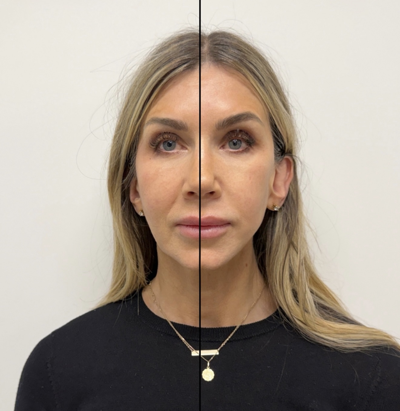 Before and after full face photo showing reduced nasolabial folds and a sharper jawline from XERF at ANO Shepparton
