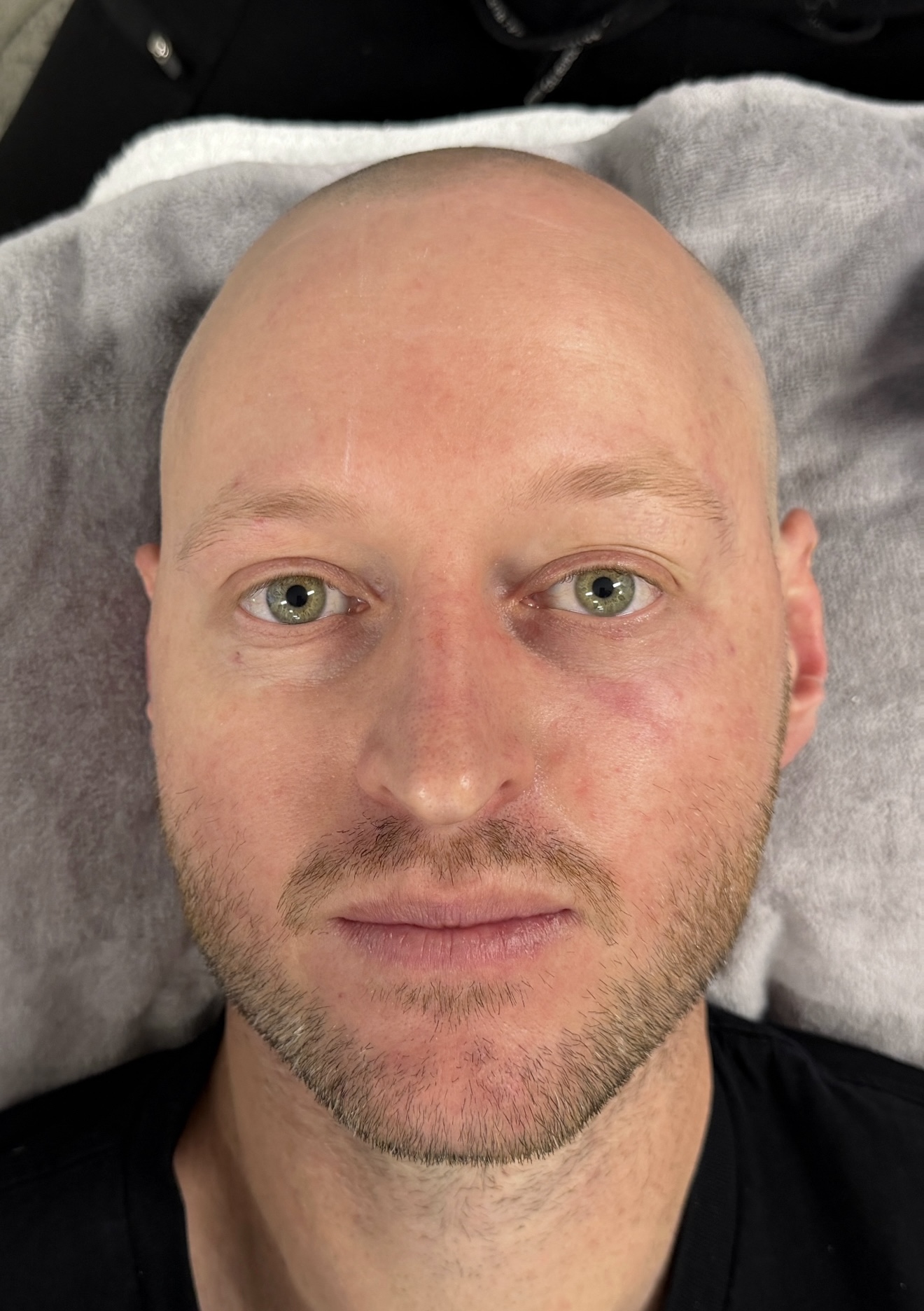 XERF skin tightening at ANO Shepparton, right side treated only, showing the difference across the brow