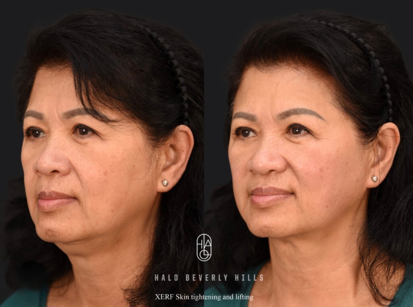 Before and after XERF lower face and neck skin tightening at ANO Shepparton