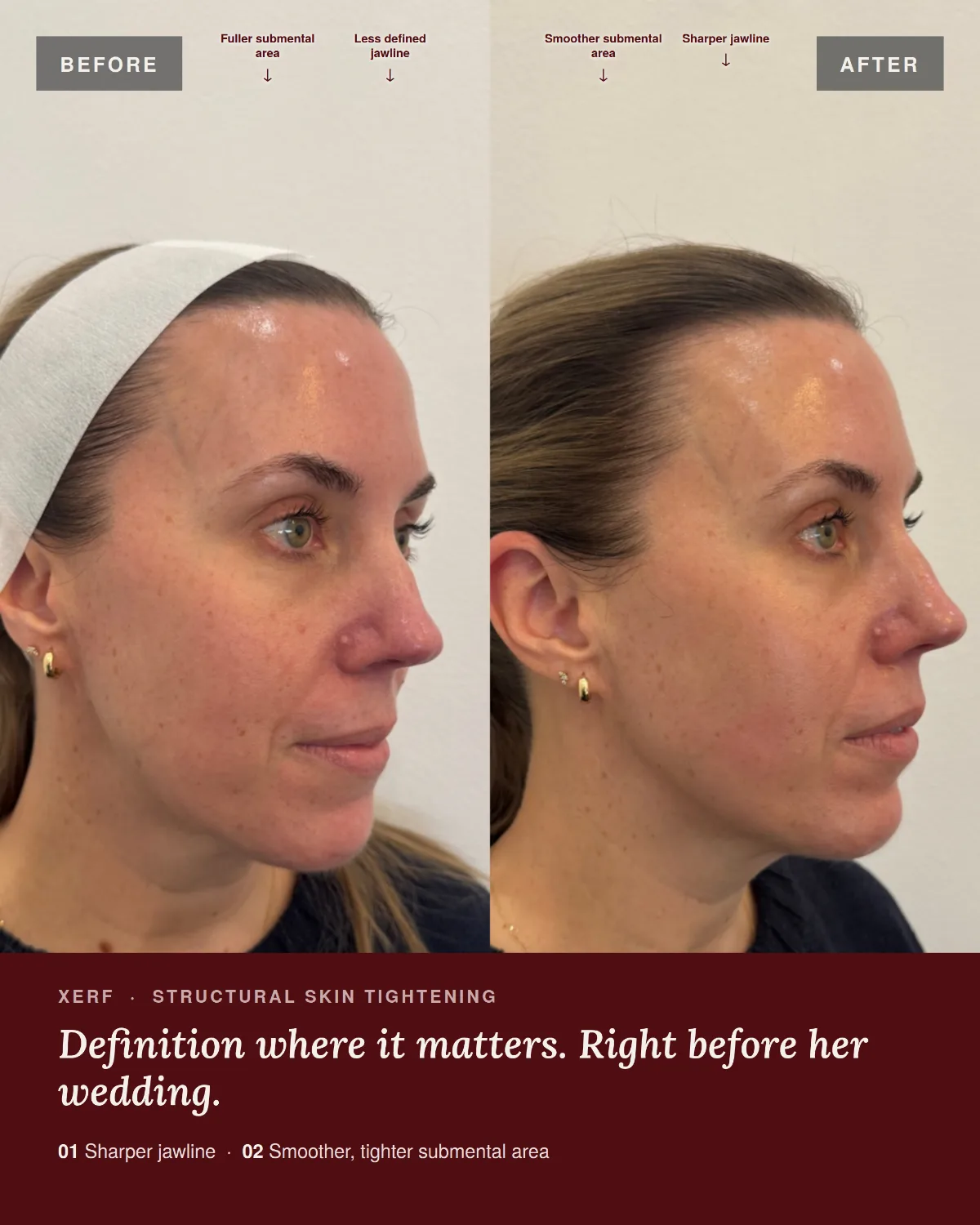 Before and after XERF skin tightening at ANO Shepparton, three-quarter view showing a sharper jawline and smoother submental area