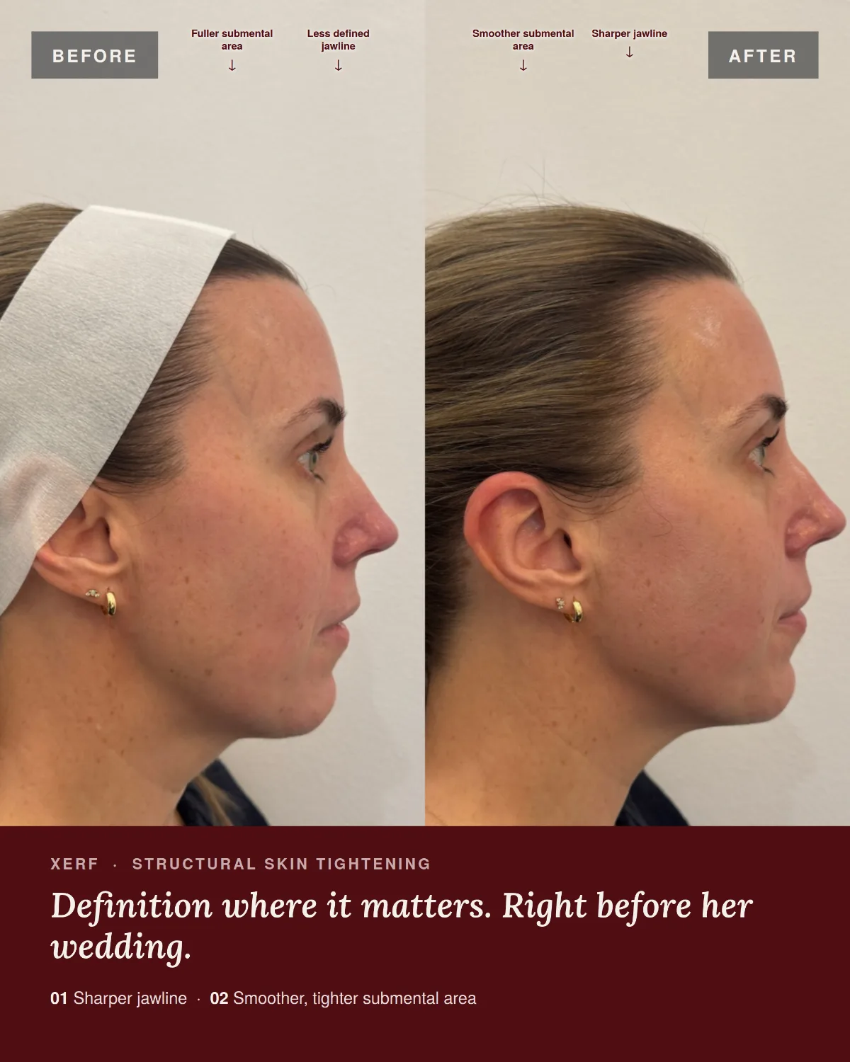 Before and after XERF skin tightening at ANO Shepparton, side profile showing a sharper jawline and smoother submental area