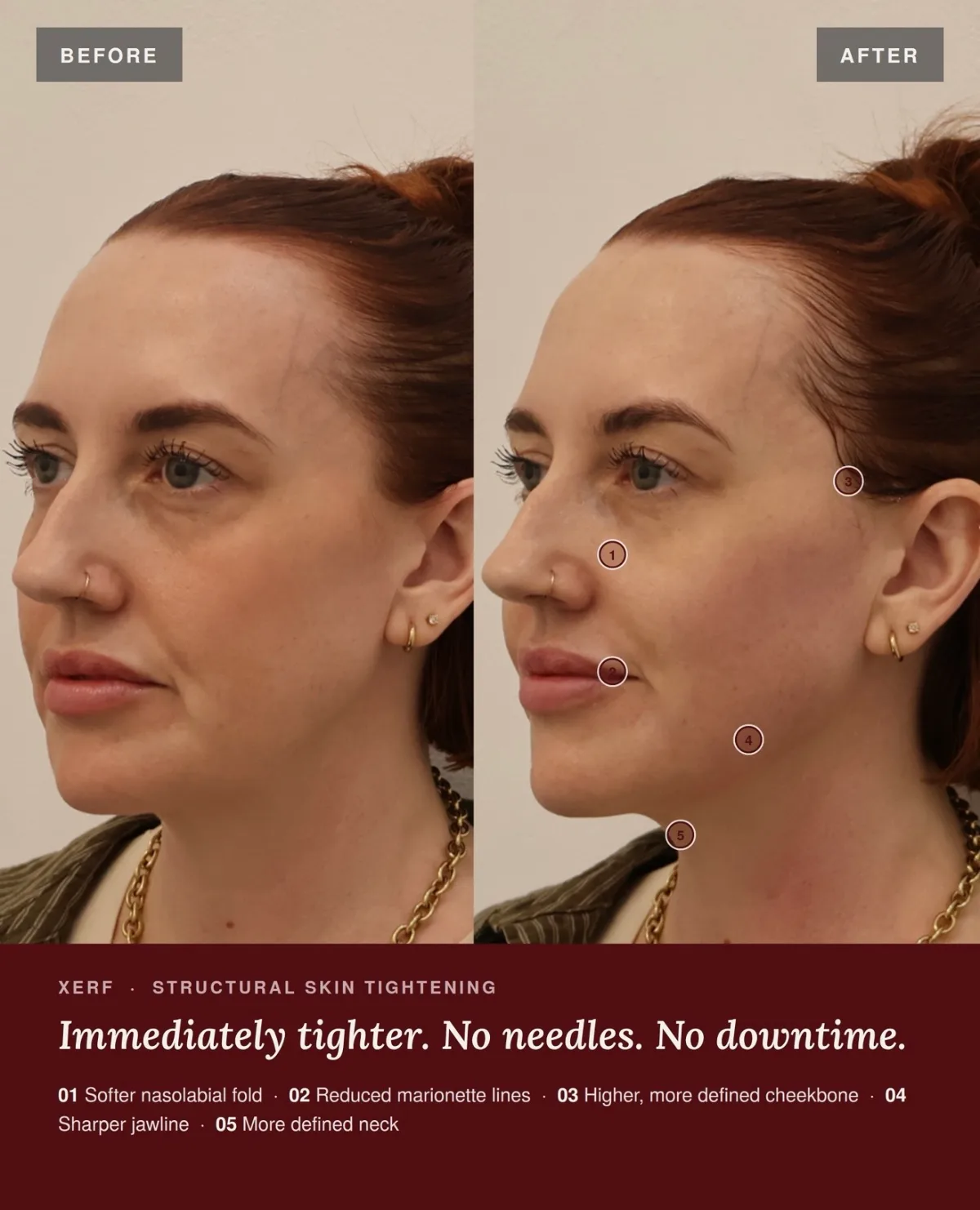 Before and after XERF skin tightening at ANO Shepparton showing a softer nasolabial fold, reduced marionette lines and a more defined jawline and neck