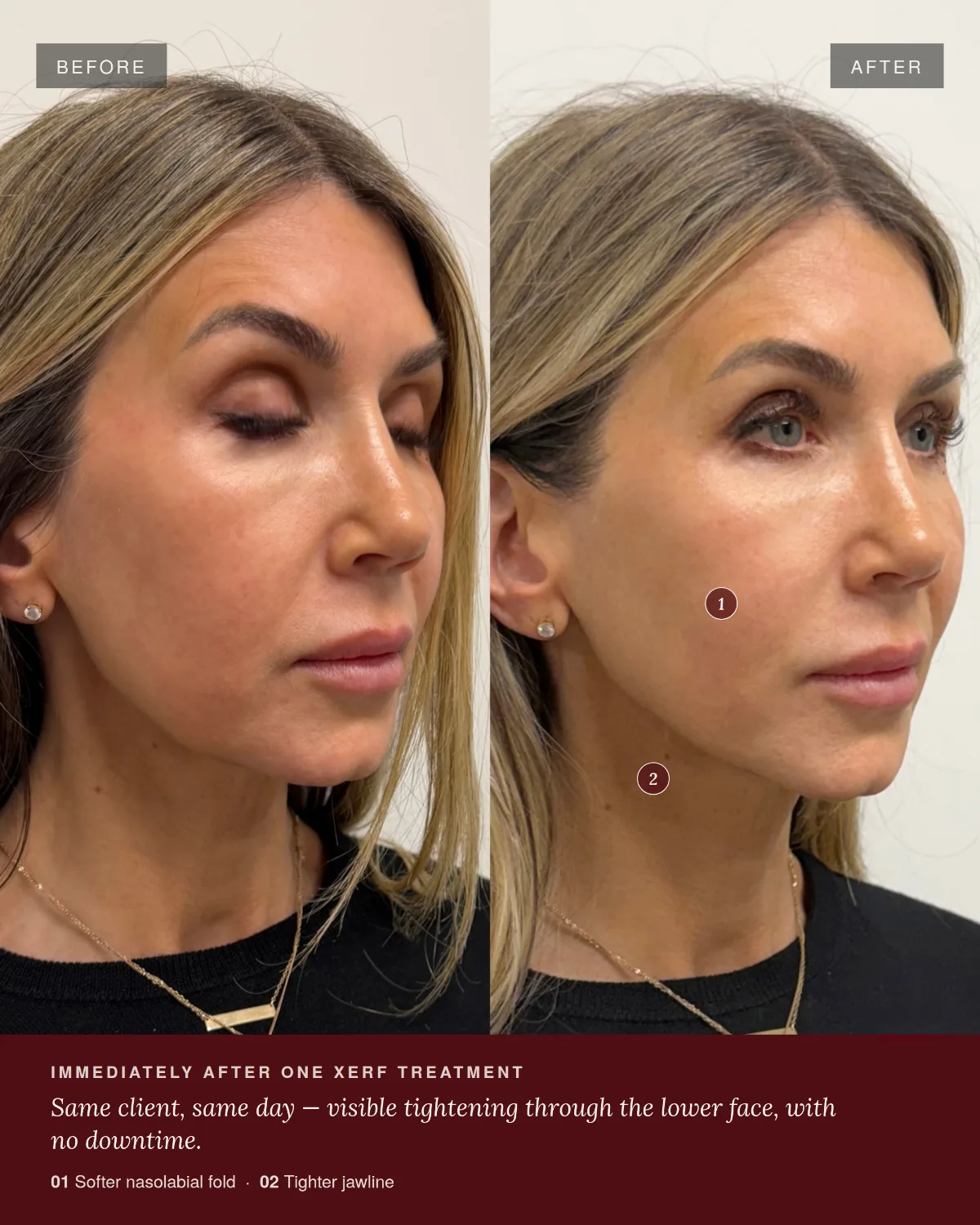 Before and after one XERF skin tightening treatment at ANO Shepparton showing tightening through the lower face and jawline