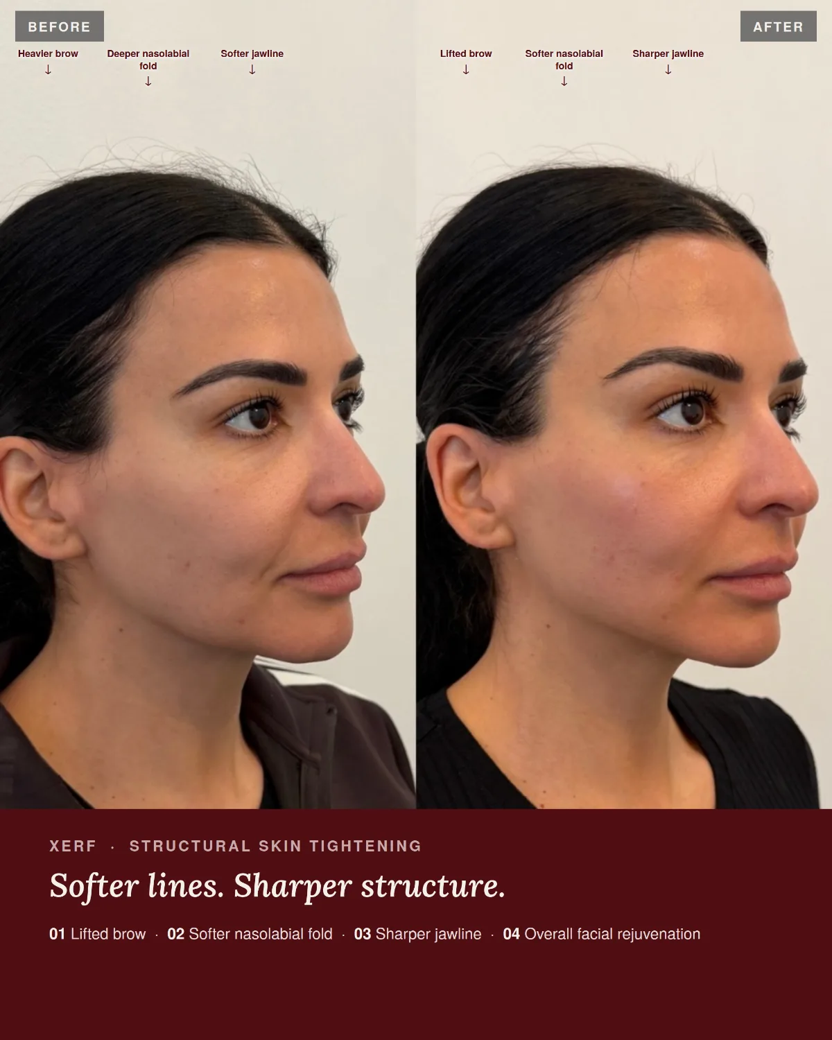 Before and after XERF skin tightening at ANO Cosmetics and Skin Shepparton, three-quarter view showing a softer nasolabial fold and sharper jawline