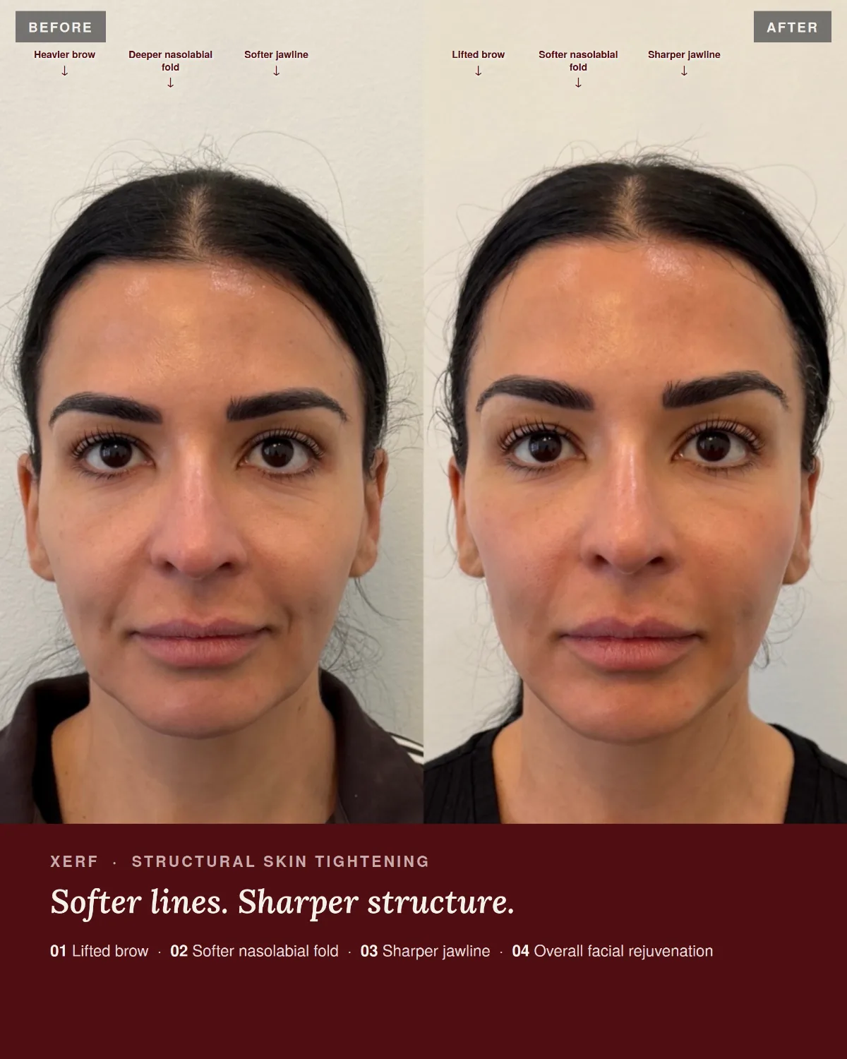Before and after XERF skin tightening at ANO Cosmetics and Skin Shepparton, front view showing softer lines and sharper facial structure