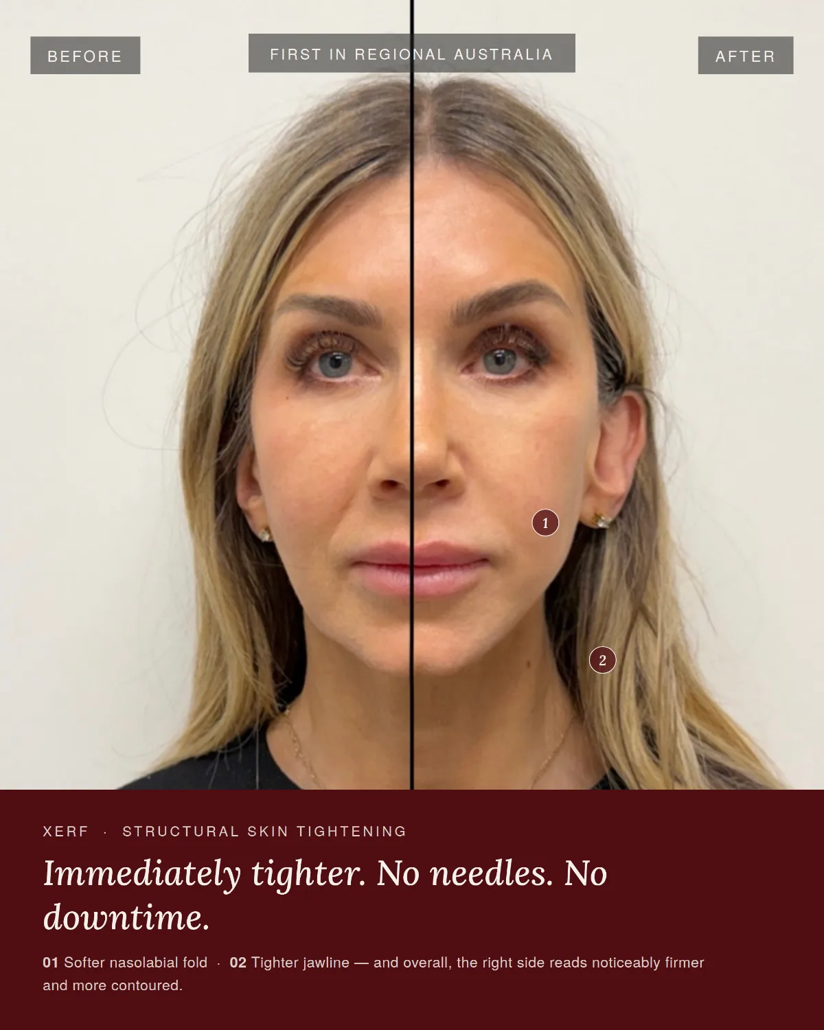 XERF skin tightening at ANO Shepparton, comparison of the untreated and treated side showing a softer nasolabial fold and tighter jawline